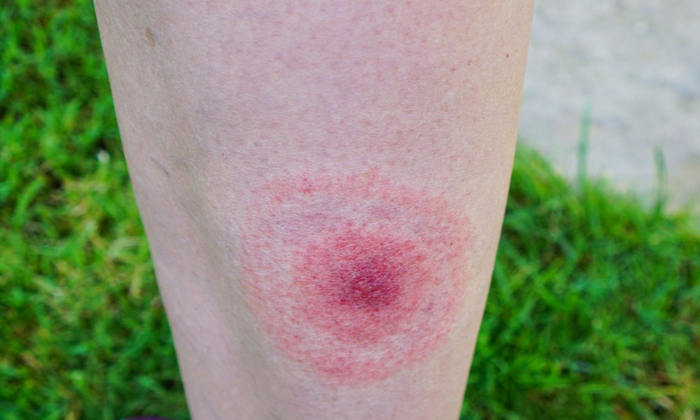 Beyond the Tick Bite: A Closer Look at Being Born with Lyme Disease